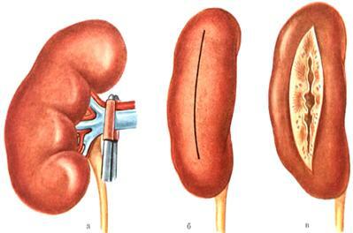 Operations with kidney stones