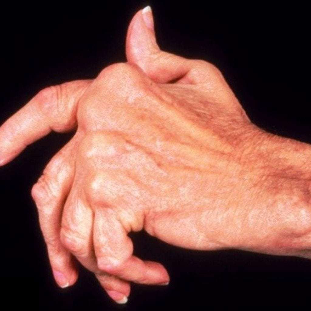 Reumatische artritis: oorzaken, symptomen en behandeling