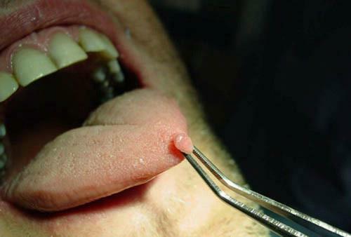 Verruche sulla lingua - si può curare?