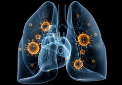 Lunginflammation hos vuxna