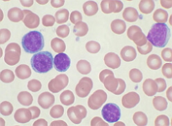 Lymfocytisk leukemi