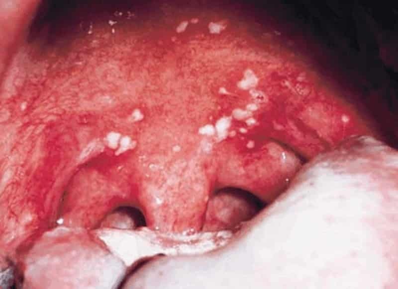 Bubblan i munnen mucosa: det vill säga hur man behandlar, foto