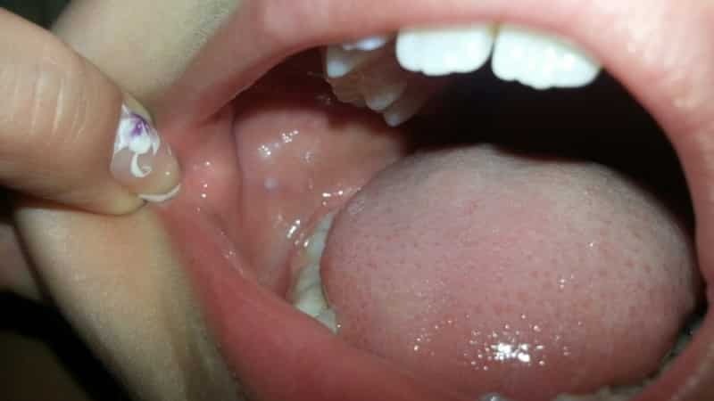 bolovima u ustima djeteta