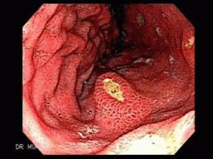 Anacid gastritis: oorzaken, symptomen en behandeling