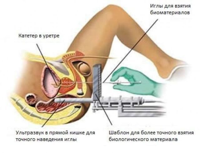 What is a biopsy of the prostate?