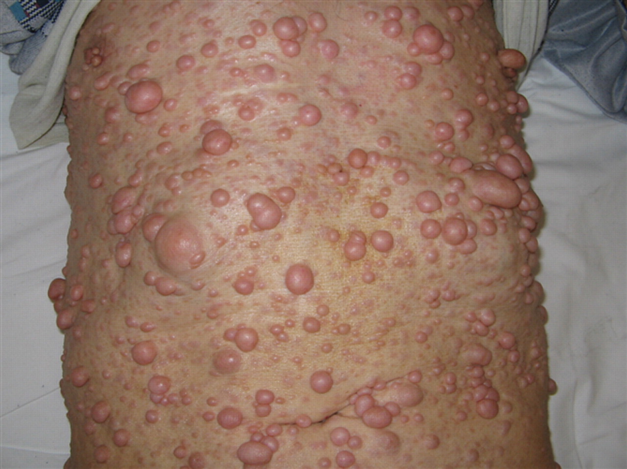 Neurofibromatóza: čo to je, príznaky, liečba, prognóza