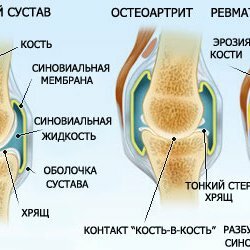 Development of rheumatoid arthritis