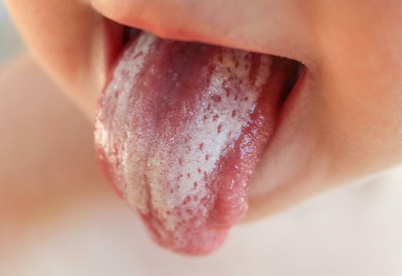 macchie bianche sulla mucosa della bocca