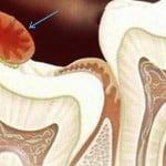 The reasons for removing the hood of wisdom tooth