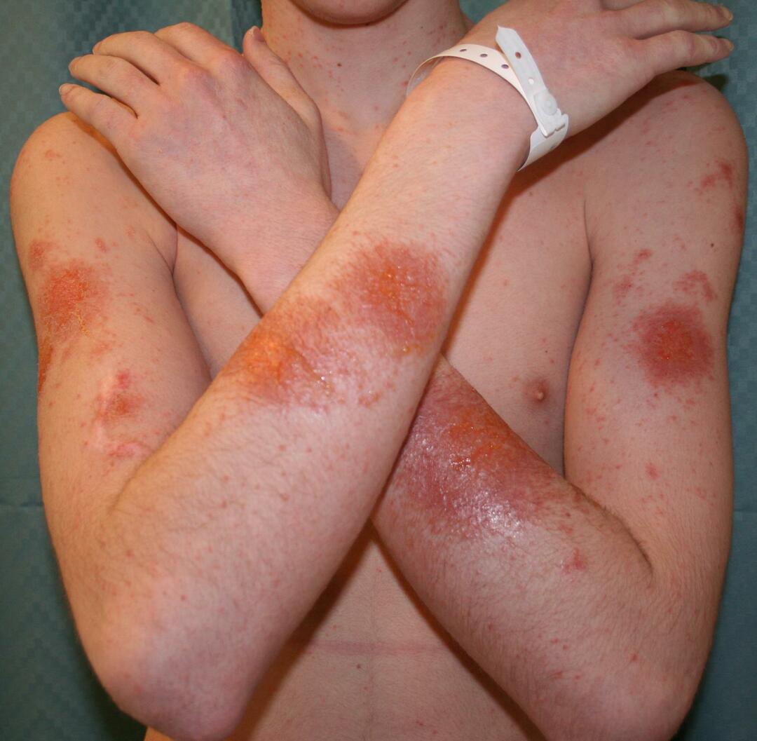 Clinical manifestations of contact allergy