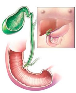 Acalculeuze cholecystitis