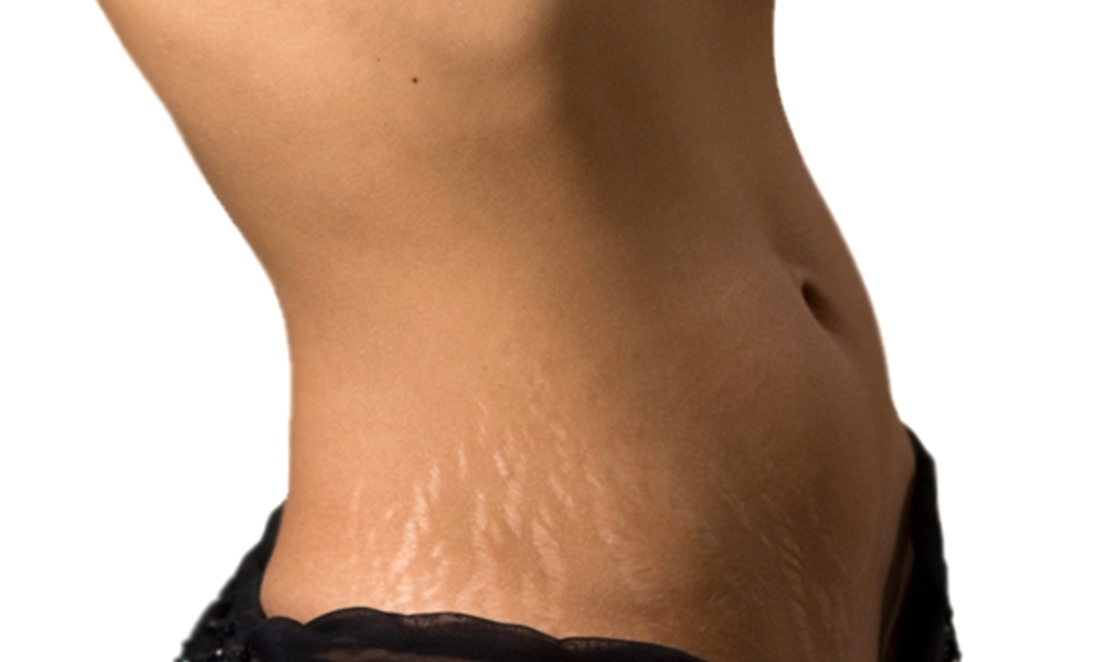 Striae( stretch marks on the skin): the causes of the appearance, the ways of treatment