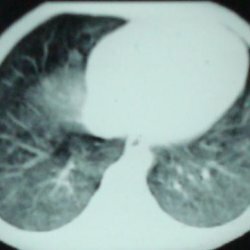 A tüdő idiopátiás hemosiderosis