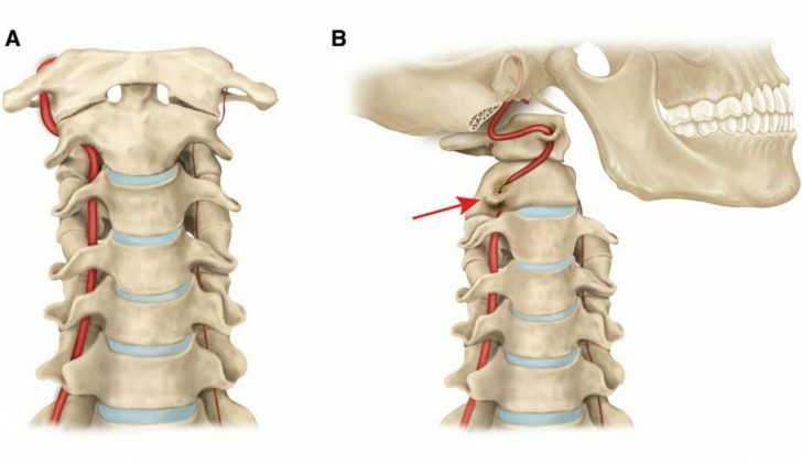 Syndrome of the vertebral artery: symptoms and treatment