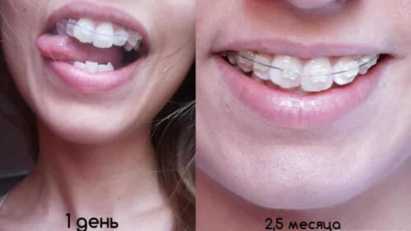 Zähne Foto vor und nach den Zahnspange