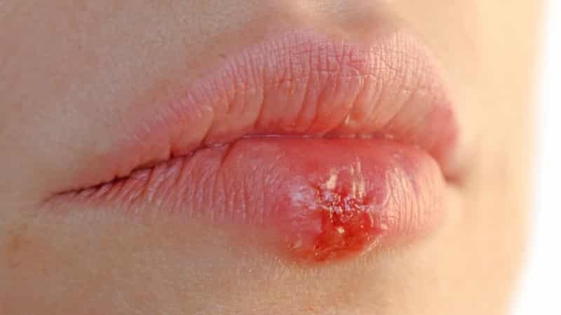 Ob Herpes ist gefährlich, auf den Lippen der Schwangerschaft im zweiten Trimester