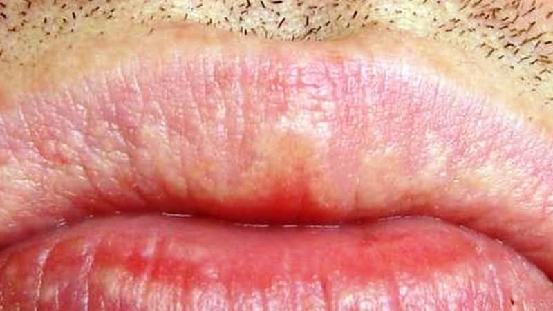 weißer Fleck auf der Lippe