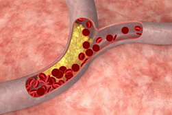 Hiperkolesterolemia