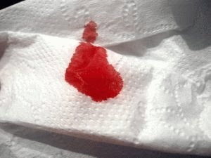 Burst-aambeien: wat te doen en hoe het bloeden te stoppen?