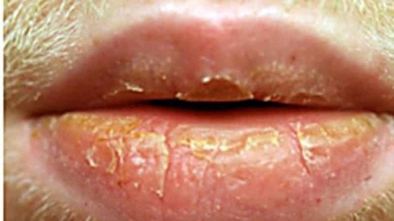 cheilitis auf den Lippen Foto