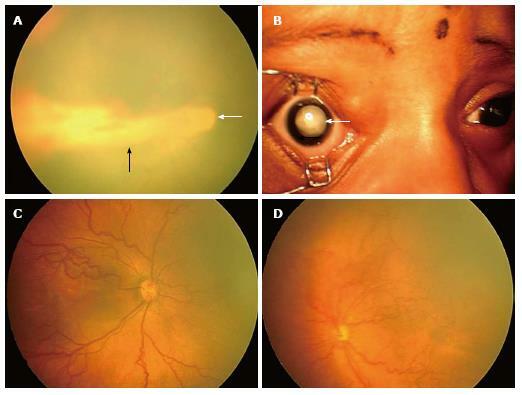 Ennenaikaisuuden retinopatia: mikä se on, syyt, oireet, hoito, ennuste