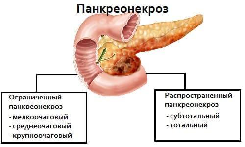 Classificação da necrose pancreática