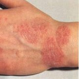 Folk Heilmittel für Dermatitis
