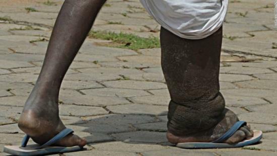 Clonovya choroba noga słoniowacina, słoniowacina, objawy i leczenie