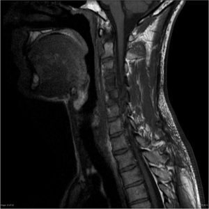 Myositis a nyakon