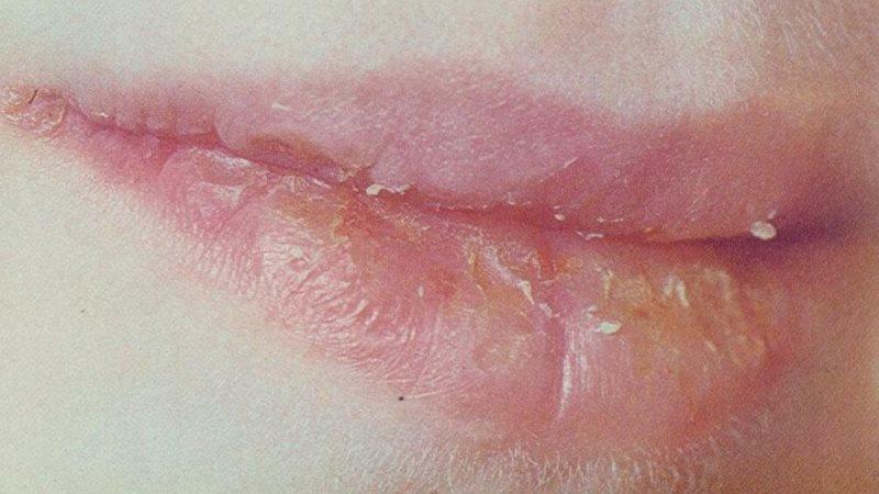 aktinische Cheilitis auf den Lippen Behandlung Salbe