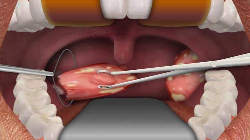 of tonsillen in chronische tonsillitis verwijderen