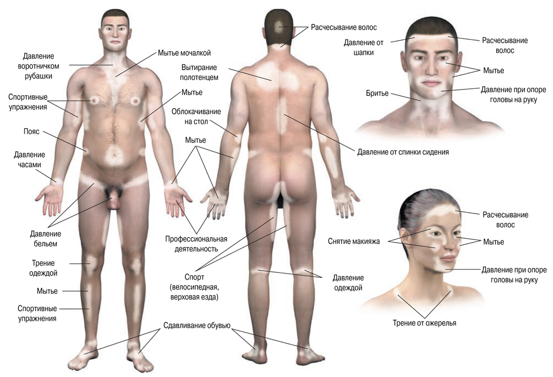 Hvordan behandle vitiligo?