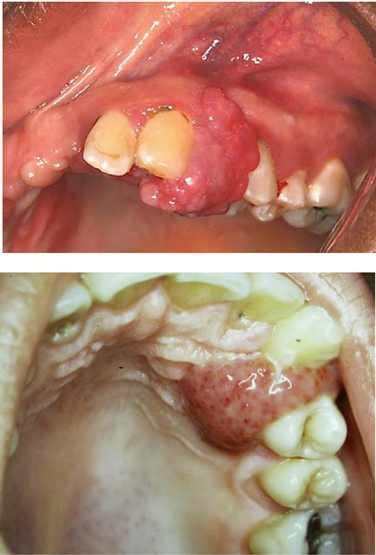 Hammaste granuloom: mis see on, sümptomid, kuidas ravitakse hamba granuloomi