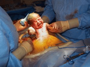 Hemorroides después de una cesárea: cómo tratar, exacerbaciones posparto