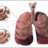 Emphysema of the lung: treatment
