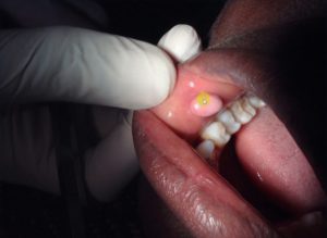 Epitheliale polyposis