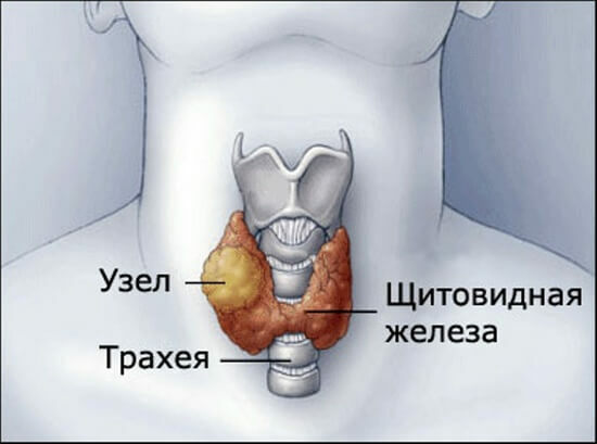 Nodular goiter of the thyroid: symptoms and treatment