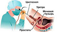 Uretroscopie met ontsteking van de halve knollen