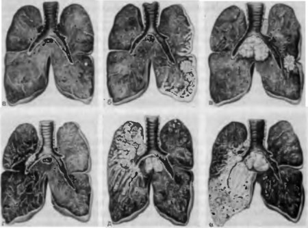 Vrste raka pluća