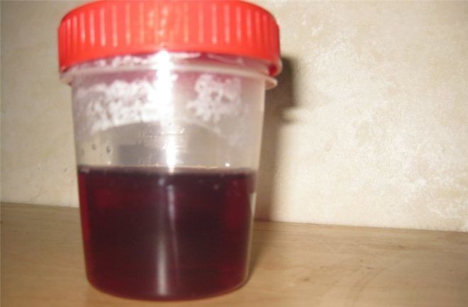 McArdlova choroba: čo to je, príčiny, symptómy, liečba, prognóza