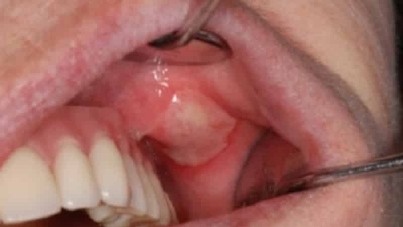 Objawy zapalenia jamy ustnej: wczesne oznaki dziecka i osoby dorosłej