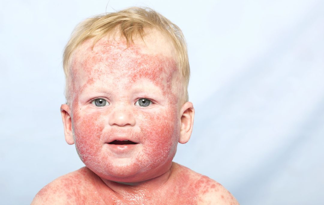 Atopic dermatitis in a child: causes, symptoms and treatment