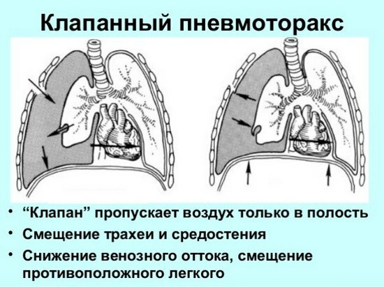 Valve pneumothorax