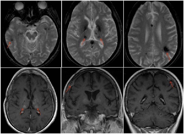 MRI s kromosoma mozga
