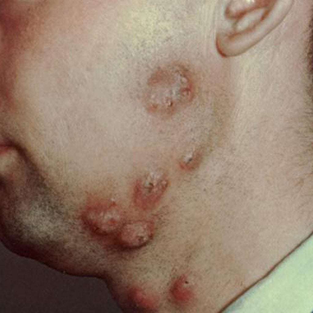 Ringworm in humans: photo, initial stage, symptoms