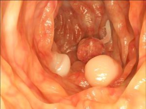 Slokdarmpoliep: oorzaken, symptomen en behandeling