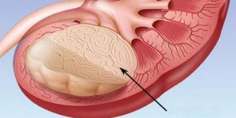Angiomyolipomen van de nier: wat is het en hoe te behandelen?