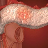 Diffuse pancreatic changes