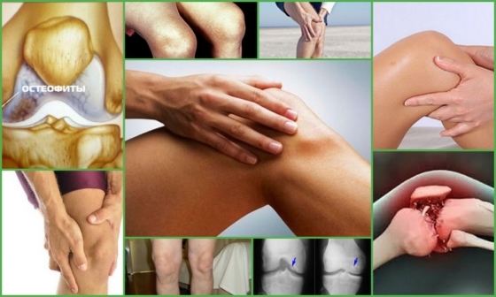 Les ostéophytes du genou: ce qu'elle est, les causes, les symptômes, le traitement