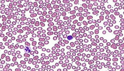 Hipochrominės anemijos nuotraukos